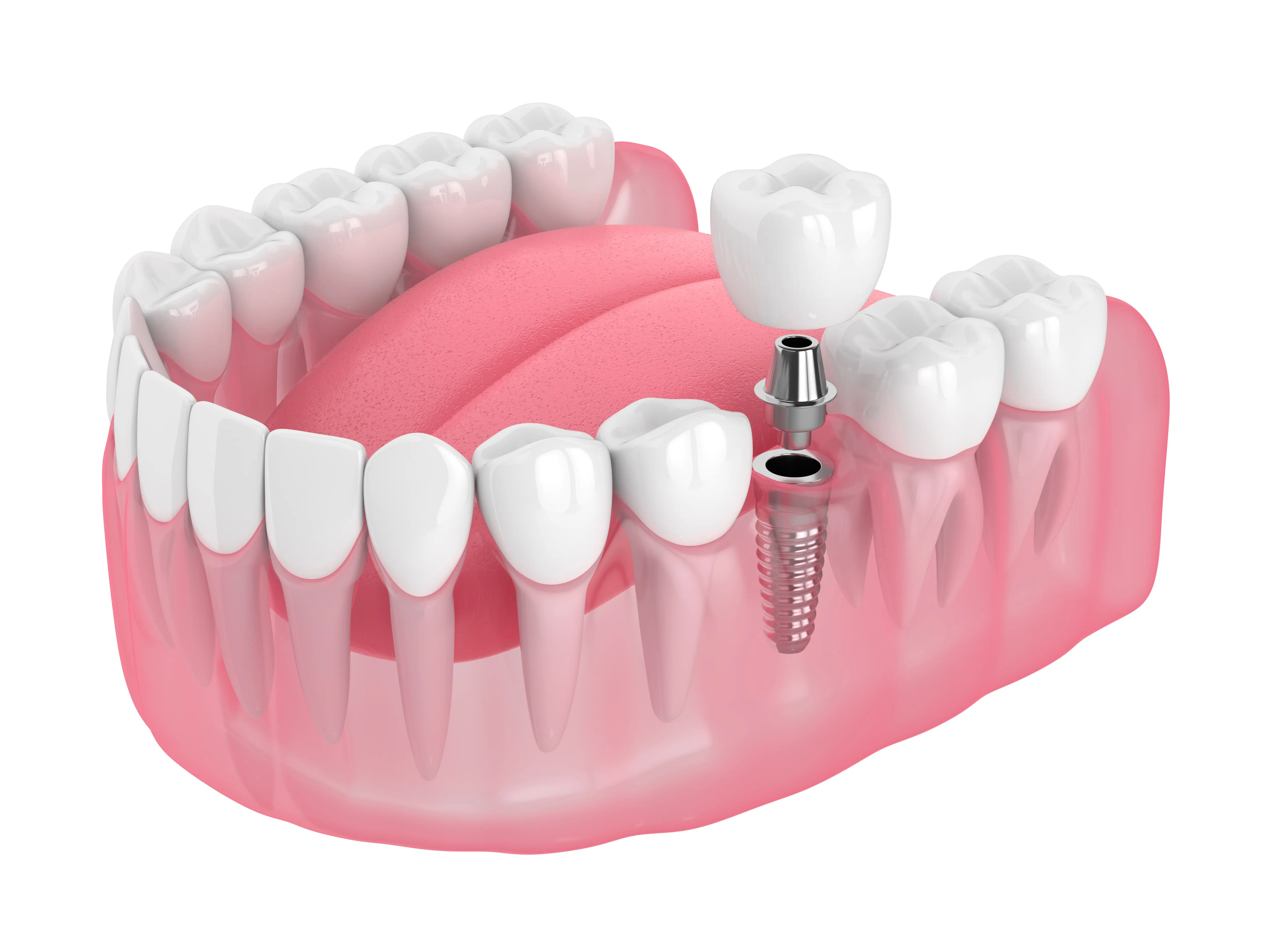 Dental Extraction in Sacramento - Ideal Dentistry
