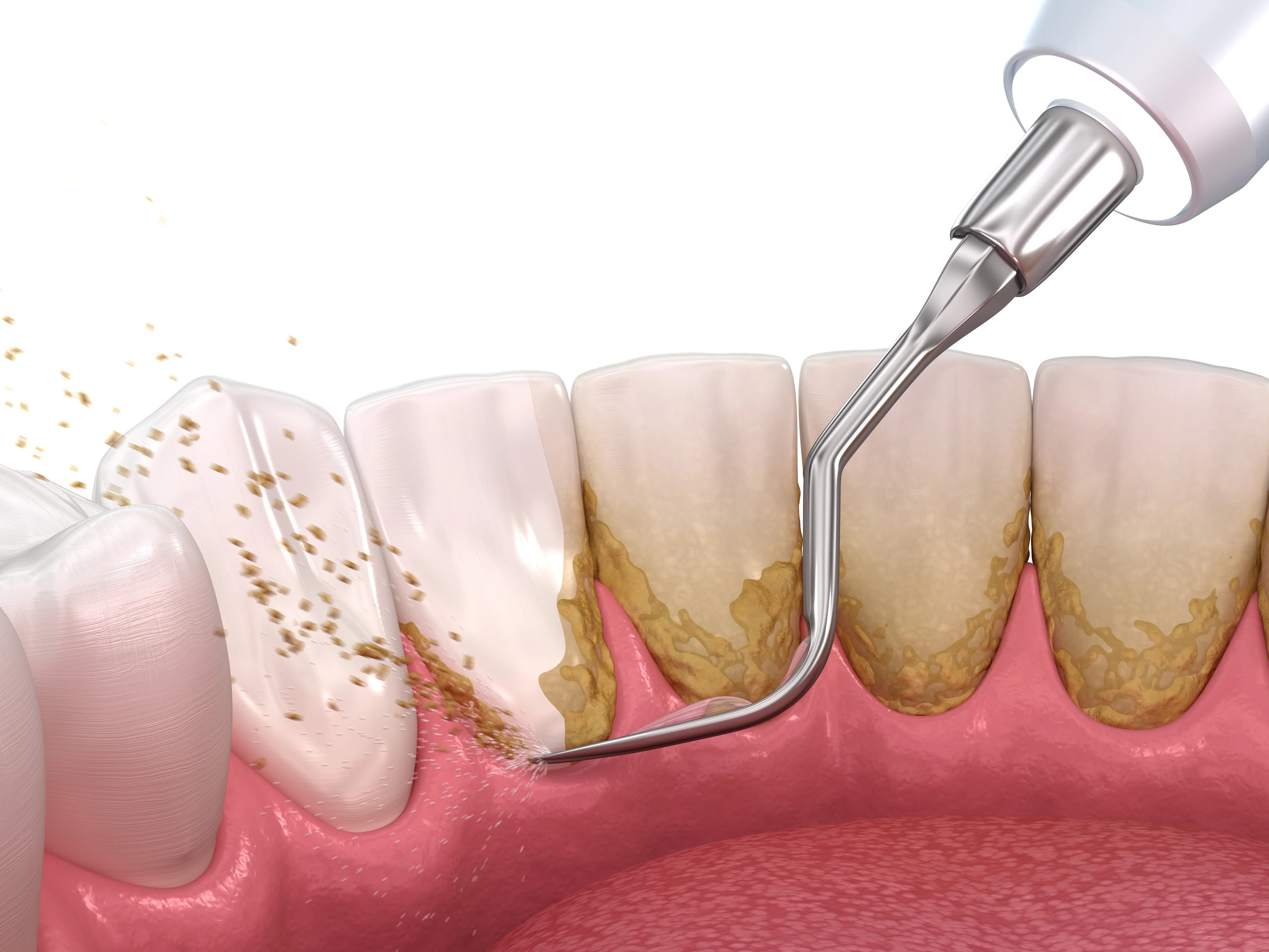 High-quality restorative dental care - Restorative Dentistry in Sacramento - Ideal Dentistry