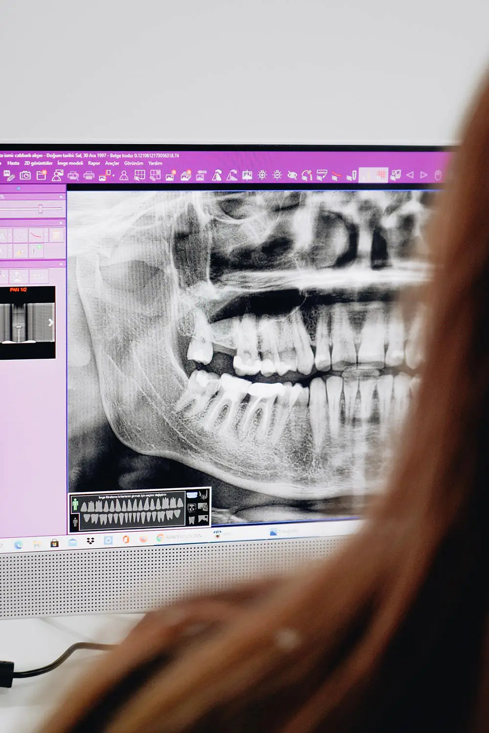 Oral Cancer Screenings - Preventative Dentistry in Sacramento - Ideal Dentistry